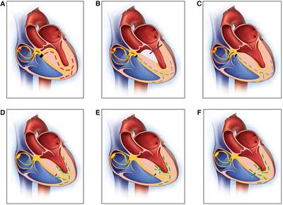 Left bundle branch pacing in third-degree atrioventricular block following morrow surgery: a case report